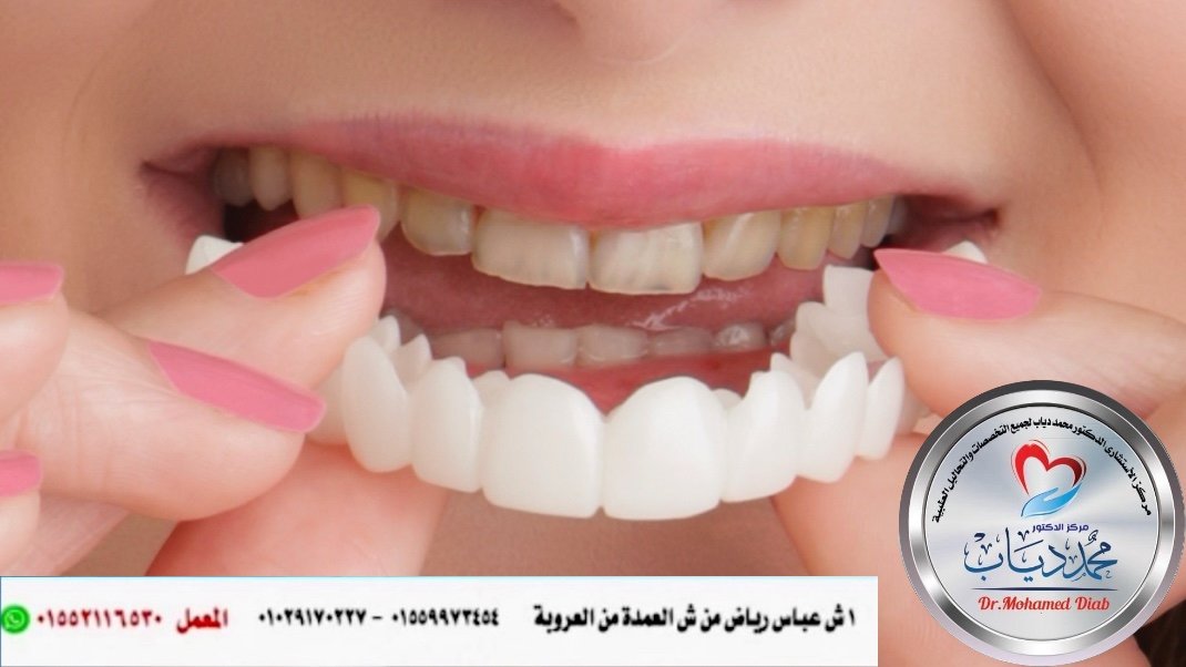 التركيب التجميلي للأسنان - محمـــــد جابـــــر