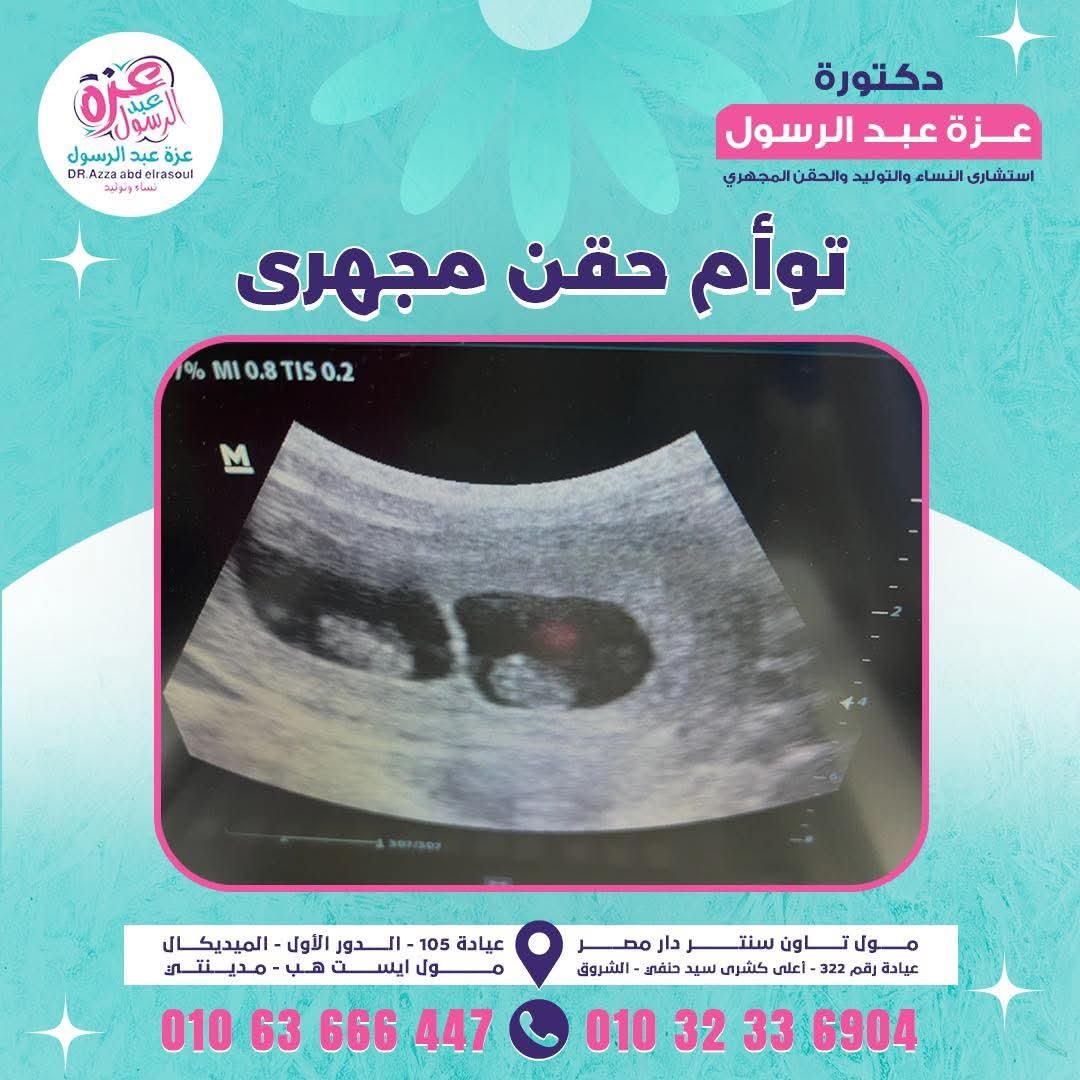 توأم حقن مجهري - عزة عبدالرسول حسن